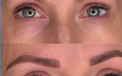Recuperando la armonía: Opciones seguras para eliminar la micropigmentación