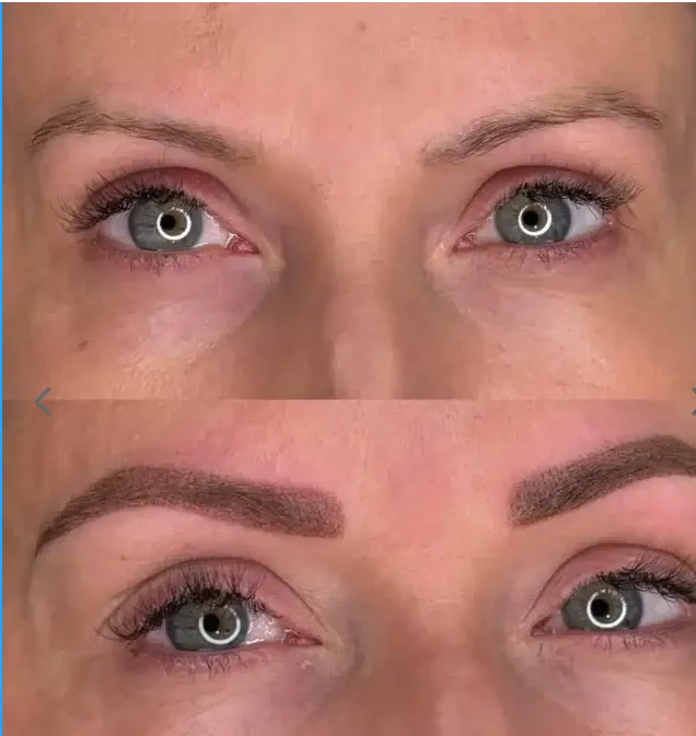 Recuperando la armonía: Opciones seguras para eliminar la micropigmentación